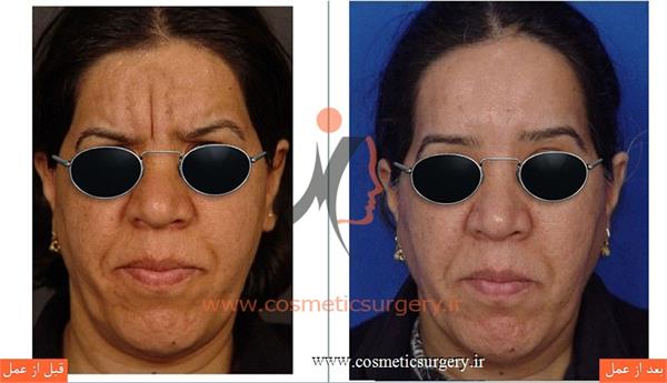 لیفت پیشانی با پوست بسیار ضخیم