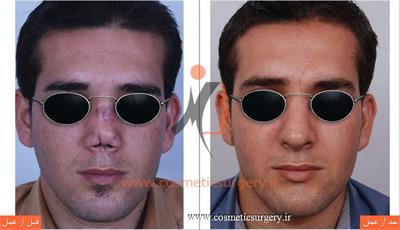 ترمیم بینی در بیماری که قبلا توسط جراحان دیگری عمل شده است