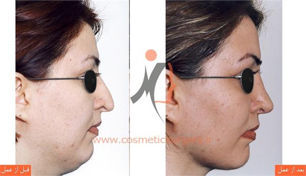 جراحی زیبایی بینی