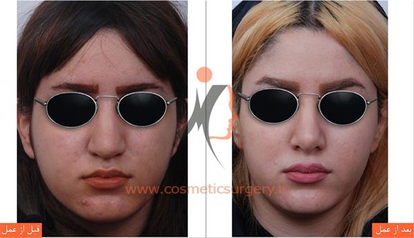 جراحی زیبایی بینی