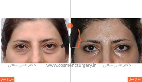 Eyelid surgery 2