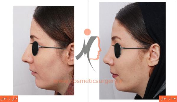 جراحی زیبایی بینی و تزریق چربی 1