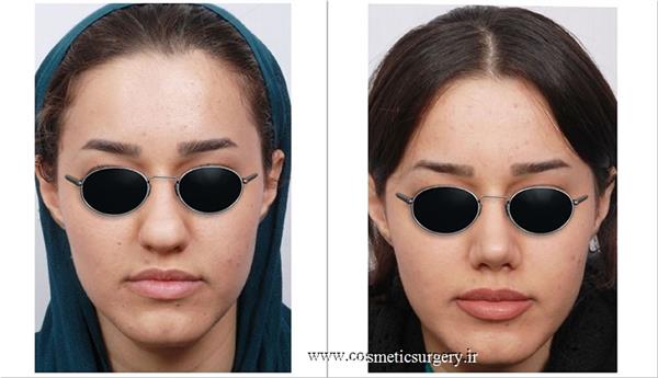 جراحی زیبایی بینی 1