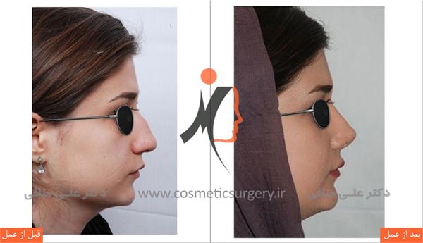 thick skinned rhinoplasty 3