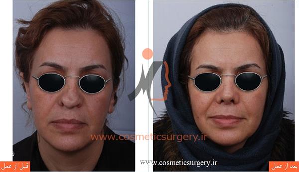 ترمیم بینی در بیماری که قبلا توسط جراحان دیگری عمل شده است