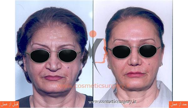 جراحی زیبایی بینی به همراه تزریق چربی و کشیدن پیشانی