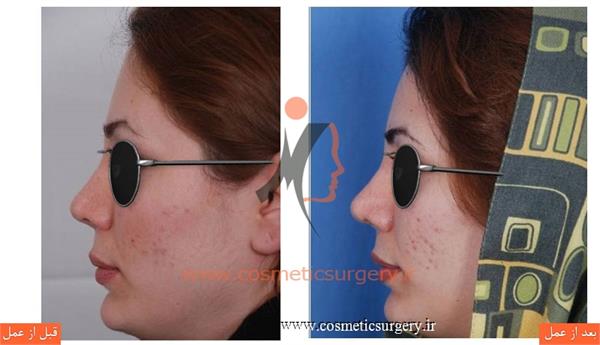 ترمیم بینی در بیماری که قبلا توسط جراحان دیگری عمل شده است