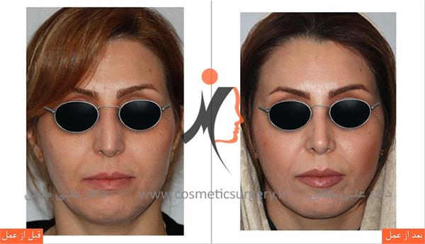 عمل جراحی زیبایی بینی 2