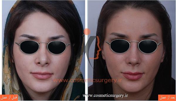 ترمیم بینی در بیماری که قبلا توسط جراحان دیگری عمل شده است