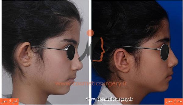 جراحی گوش ( ترمیم گوش برجسته )