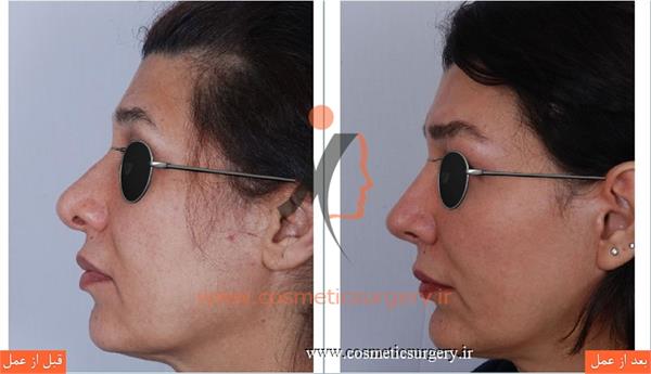 جراحی زیبایی بینی بهمراه لیفت صورت و تزریق چربی