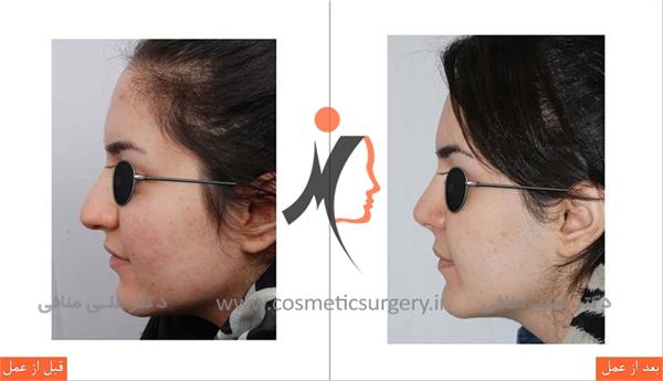 thick skinned rhinoplasty 1