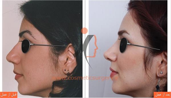 جراحی زیبایی بینی