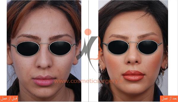 جراحی زیبایی بینی