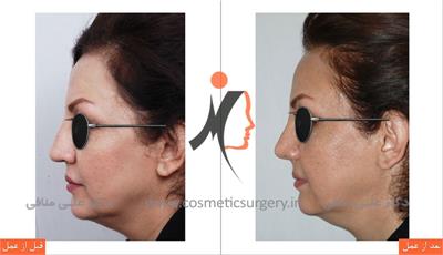 Rhinoplasty 2