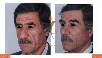 لیفت صورت و ابرو به همراه تزریق چربی و جراحی بینی