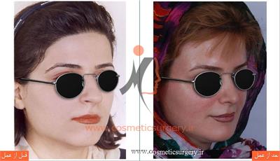 جراحی زیبایی بینی به همراه تزریق چربی -عکس بعد از 8 سال