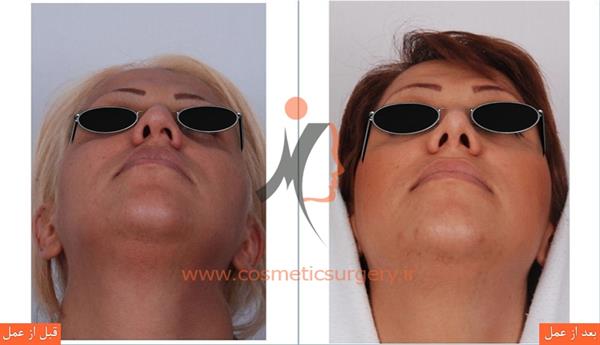 جراحی انحراف بینی