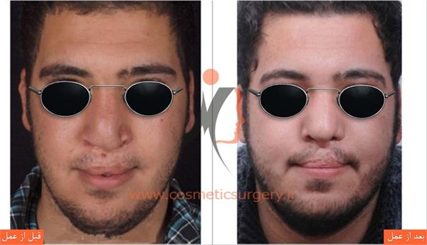جراحی زیبایی بینی در بیماران شکاف لب و کام