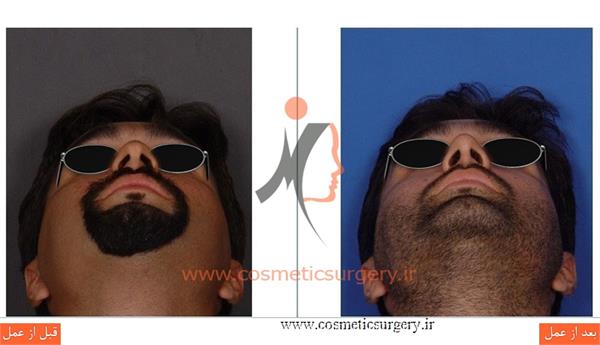 جراحی زیبایی بینی