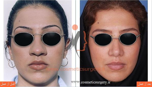 Broiler nose surgery8