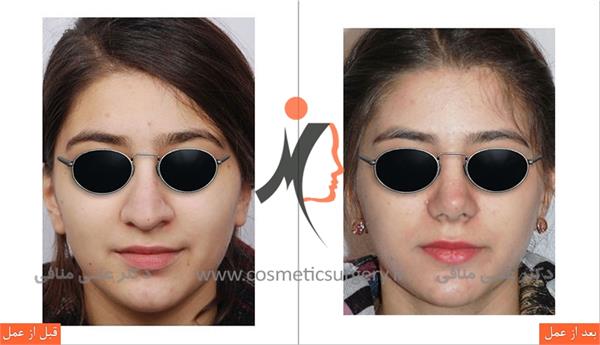 عمل جراحی انحراف بینی 1