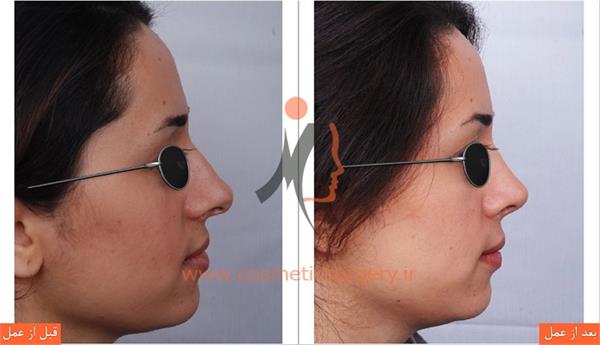 عمل جراحی انحراف بینی