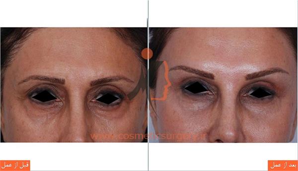 لیفت ابرو به همراه تزریق چربی