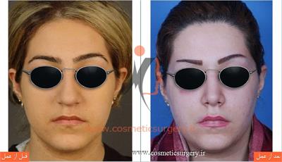جراحی زیبایی بینی