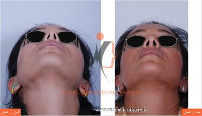 ترمیم بینی در بیماری که قبلا توسط جراحان دیگری عمل شده است