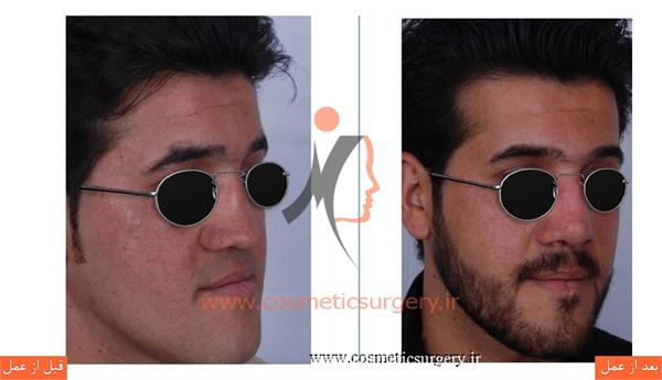 ترمیم بینی در بیماری که قبلا توسط جراحان دیگری عمل شده است