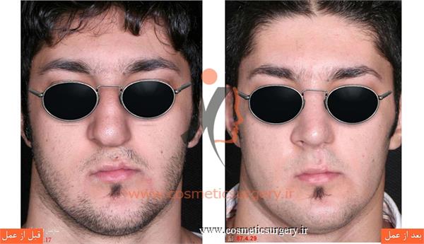 جراحی زیبایی بینی به همراه ترمیم شکاف لب و کام