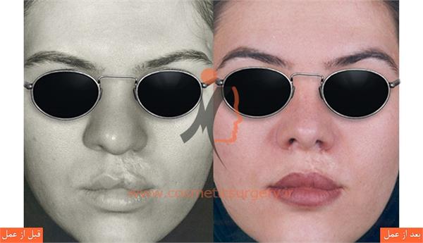 جراحی زیبایی بینی به همراه ترمیم شکاف لب و کام