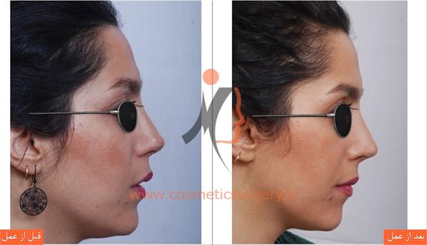 ترمیم بینی عمل شده توسط جراحان دیگر ( عمل بینی ثانویه )