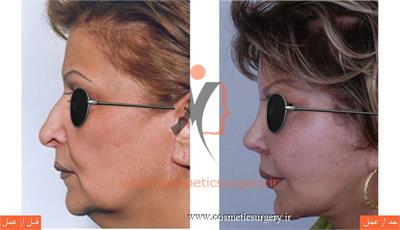 ترمیم بینی عمل شده توسط جراحان دیگر به همراه لیفت صورت و گردن ثانویه و تزریق چربی (صورت و گردن بیمار یک بار توسط جراح دیگر لیفت شده است)