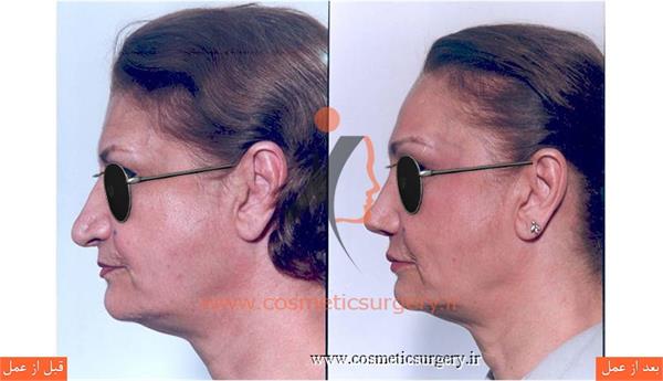 جراحی زیبایی بینی به همراه تزریق چربی