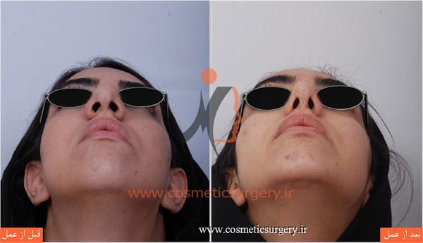عمل جراحی بینی گوشتی به همراه جراحی چانه