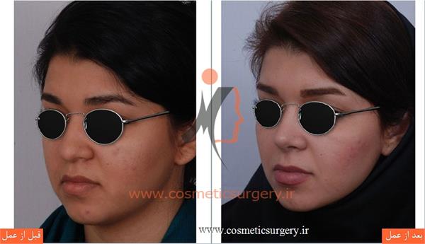 جراحی زیبایی بینی