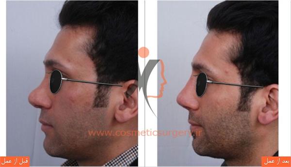 ترمیم بینی در بیماری که قبلا توسط جراحان دیگری عمل شده است