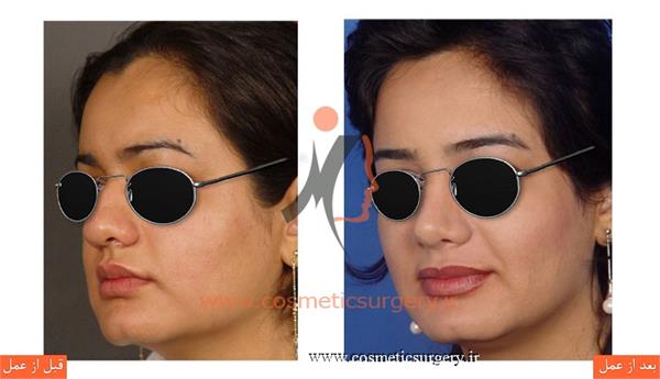 عمل جراحی بینی گوشتی