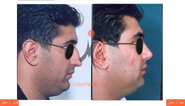 عمل جراحی انحراف بینی