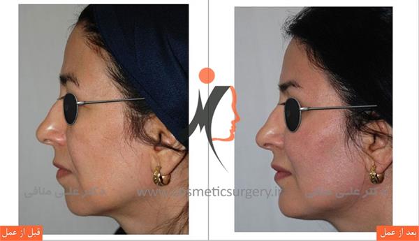 جراحی چانه لیفت ابرو 1