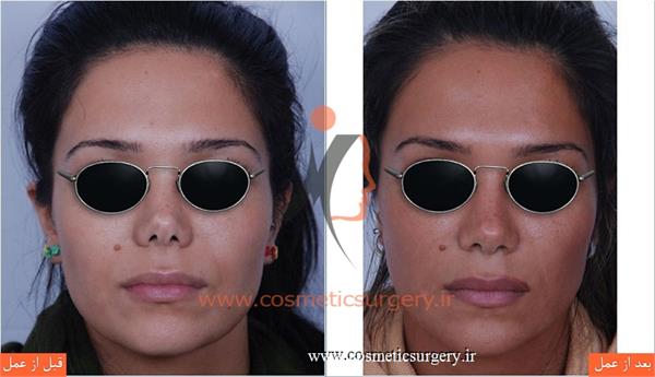 ترمیم بینی عمل شده توسط جراحان دیگر به همراه تغییر سایز بینی