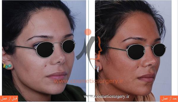 ترمیم بینی در بیماری که قبلا توسط جراحان دیگری عمل شده است