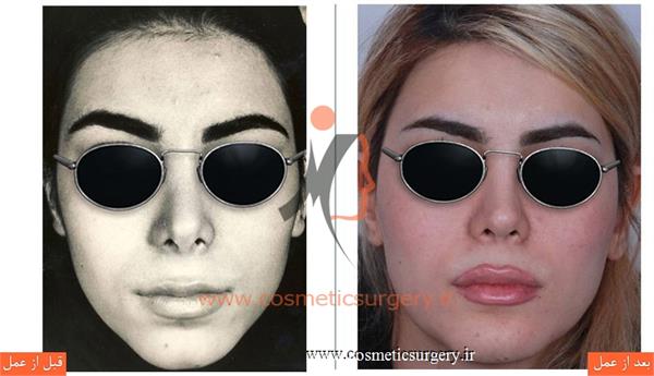 ترمیم بینی در بیماری که قبلا توسط جراحان دیگری عمل شده است