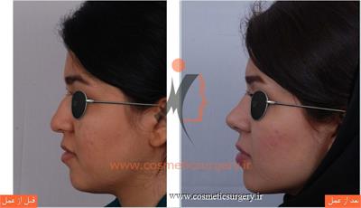 جراحی زیبایی بینی