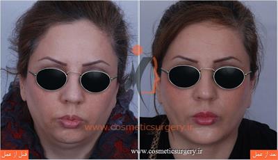 جراحی چانه به همراه تزریق چربی