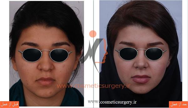 جراحی زیبایی بینی