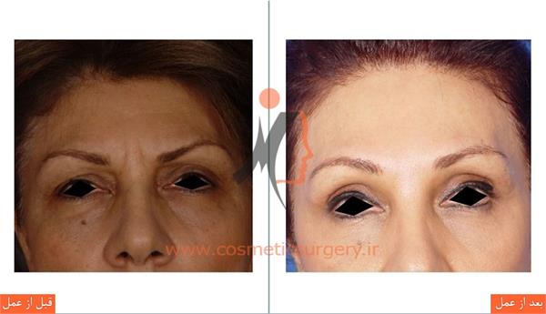 لیفت پیشانی به همراه تزریق چربی 2