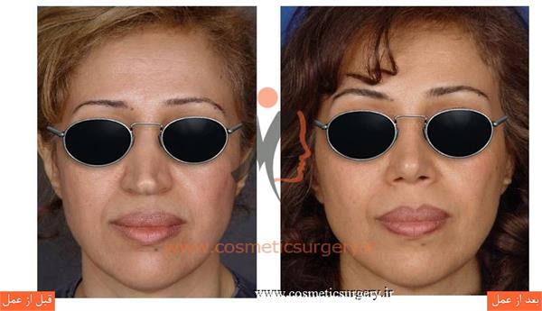 ترمیم بینی در بیماری که قبلا توسط جراحان دیگری عمل شده است